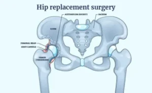 Hip Replacement Cost in India