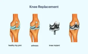 Knee Replacement Cost in India