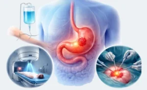 Stomach Cancer treatment cost in India