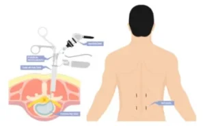 spine surgery cost in India