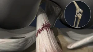 Anterior Cruciate Ligament Cost in India