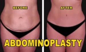 Abdominoplasty Treatment Cost in India