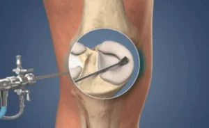 Arhtroscopy surgery cost in India