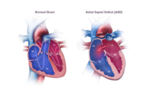Atrial Septal Defect (ASD) Surgery cost in India