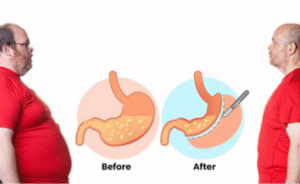 Bariatric Surgery Cost in India