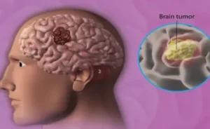 Brain tumor surgery cost in India