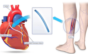 Bypass surgery cost in India