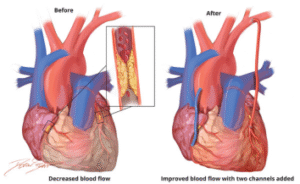 Coronary Artery Bypass Graft (CABG) Surgery Cost in India