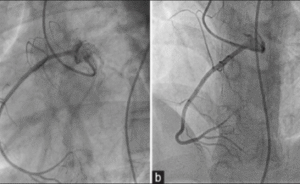 Coronary angiography cost in India