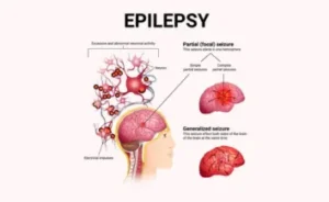 Epilesy surgery cost in India