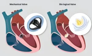 Heart Valve Replacement cost in India