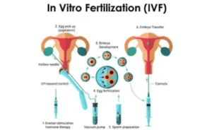 IVF Treament cost in India