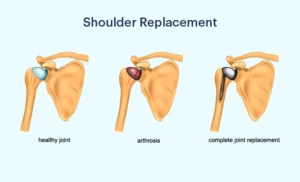 Shoulder replacement surgery cost in India