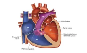 VSD Surgery cost in India