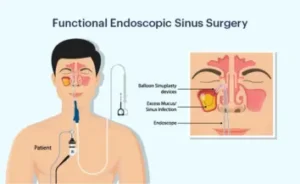 Sinus Surgery Cost in India