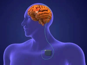 Deep Brain Stimulation Surgery Cost in India