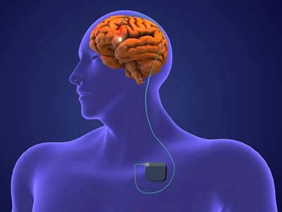 Deep Brain Stimulation Surgery Cost in India